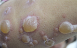 Rare Skin Blistering Disorder Successfully Treated at Thumbay Hospital Dubai